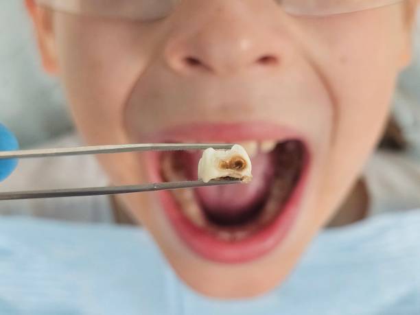 Best Emergency Tooth Extraction in Emerson, NJ